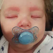 It causes swelling of the meninges. Horrifying Photos Show How Meningitis Rash Grew From A Few Dots To Cover Baby S Whole Body In 24 Hours Mirror Online