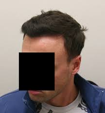 best hair transplant results photos