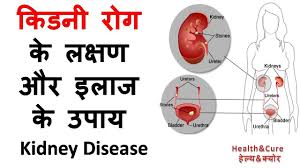 Kidney Rog Ke Lakshan Aur Ilaj Ke Upay Kidney Disease In