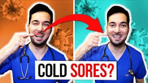 cold sores on lips fast and treatment