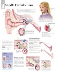 Middle Ear Infections