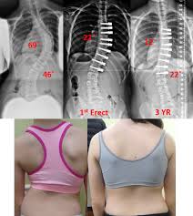 two scoliosis surgery options that aren