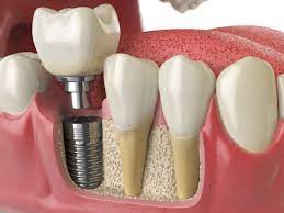 implant dentar cluj pret detalii
