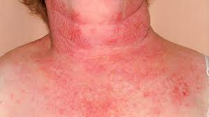 skin conditions ociated with hiv