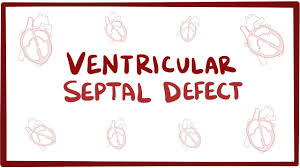 Ventricular Septal Defect Vsd An Osmosis Preview