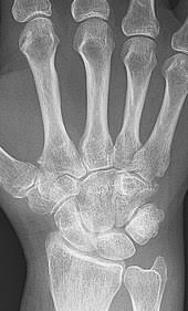 Rheumatoid Arthritis Wikipedia