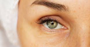 eye basics 101 what causes puffy eyes