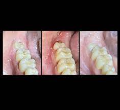 periodontal disease and wisdom teeth