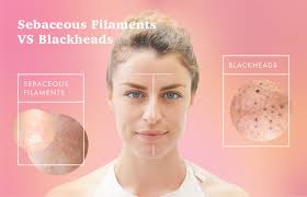 sebaceous filaments vs blackheads how