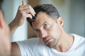 hair loss in men due to hormonal