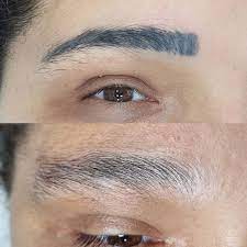 laser permanent makeup removal all