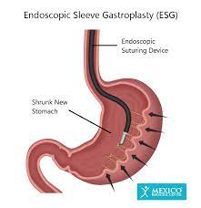 endoscopic sleeve gastroplasty esg in