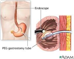 gastrostomy placement series