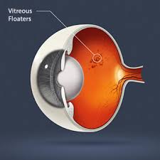 eye floaters causes symptoms