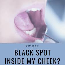 Usually dentists diagnose the presence of mouth cancer in warning: What Is The Black Spot On The Inside Of My Cheek