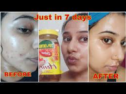 7 days challenge remove pimple marks