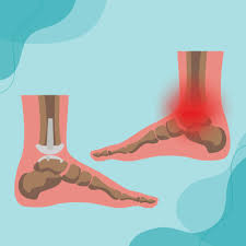ankle replacement surgery orthopaedic
