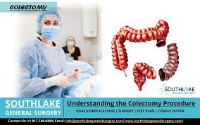 understanding the colectomy procedure