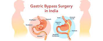 gastric byp surgery cost abroad
