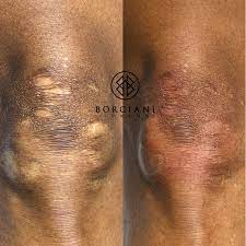 scar camouflage scar removal and scar