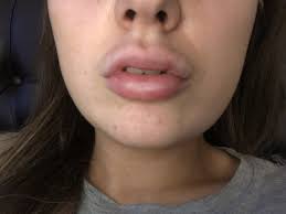 can lip filler be moved in the lip