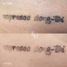 rapid laser tattoo removal the laser