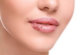 white spots on your lips indicates