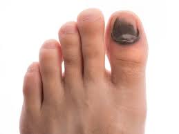 black toenail 5 common causes and