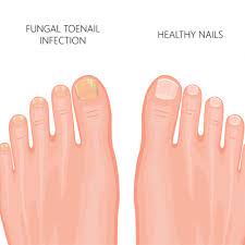 toenail fungus infection treatment and