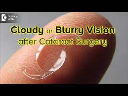 cloudy after cataract surgery