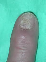 mucous cyst of thumb or finger