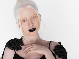 blind woman with albinism explains how