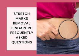 stretch marks removal singapore