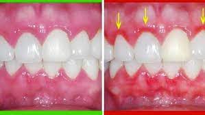 caring for red and swollen gums