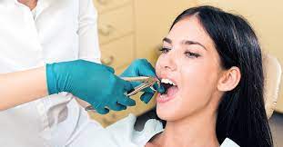 Tooth Extraction: The Top Signs a Tooth Extraction is Needed