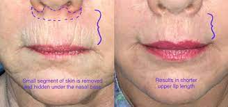 lip lift lisa taylor plastic surgery