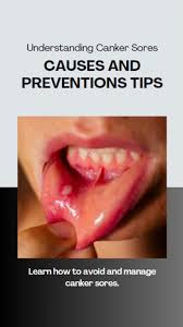 kick out canker sores understanding