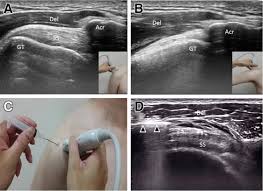 A sacroiliac joint injection is designed to diagnose and treat pain and inflammation from sacroiliac joint dysfunction. Static And Dynamic Shoulder Imaging To Predict Initial Effectiveness And Recurrence After Ultrasound Guided Subacromial Corticosteroid Injections Archives Of Physical Medicine And Rehabilitation