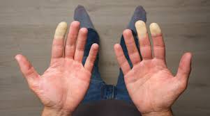 raynaud s syndrome symptoms and