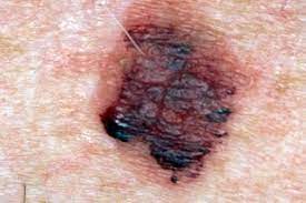 Of course, your specialist is the main person whose advice you should follow but it doesn't do anyone harm. Melanoma Skin Cancer Nhs