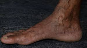 spider veins on the ankles causes