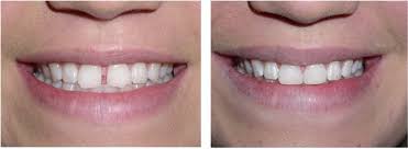 Porcelain veneers are another popular way to fix a gap in the teeth. What Is Tooth Bonding Can It Work For The Front Teeth Trucare Dentistry Roswell