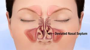 the problems a deviated nasal septum