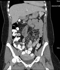 Some people refer to a ct scan as a cat scan, which stands for computerized axial tomography. The Challenge Of Diagnosing Abdominal Pain And Diarrhea Medpage Today