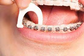 But have you heard about floss or elastic band braces? How To Floss With Braces