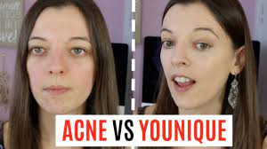 acne une journée avec le fdt younique