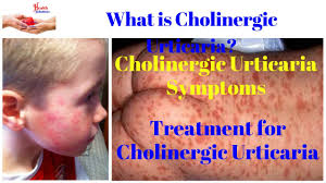 cholinergic urticaria symptoms