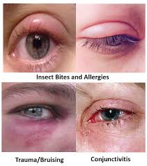 swollen eyelid know the causes