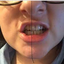 misaligned teeth and uneven lips photo