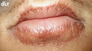 get rid of chapped lips fast using